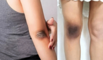 হাঁটু ও কনুইয়ের জেদি কালচে দাগ দূর করার ঘরোয়া উপায়