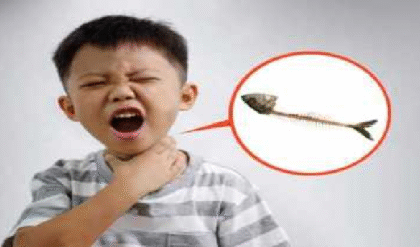 গলায় বিঁধে যাওয়া মাছের কাঁটা দূর করার ৫ সহজ ঘরোয়া উপায়