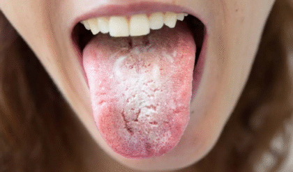 জিভের উপর সাদা আস্তরণ পড়ার কারণ জানতে চান? তাহলে তথ্যটি পড়ুন