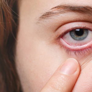 কীভাবে দূষণ আপনার চোখের ক্ষতি করে- ক্ষতিকারক প্রভাব