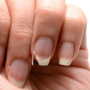 নখকুনির সমস্যায় ভুগছেন? প্রতিরোধে কি করবেন ঝটপট পড়ুন