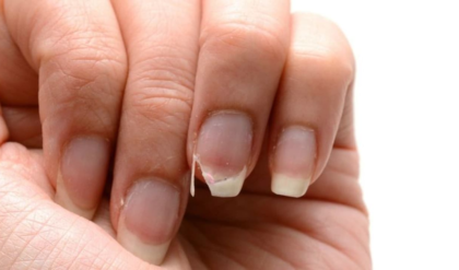 নখকুনির সমস্যায় ভুগছেন? প্রতিরোধে কি করবেন ঝটপট পড়ুন