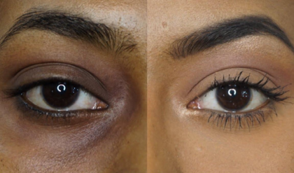 চোখের কালো দাগ মেটাতে এই অসাধারণ টোটকা আপনার জন