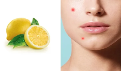 ব্রণ তাড়াতে লেবুর রস মাখছেন? ত্বকের ক্ষতি ডেকে আনছেন না তো?