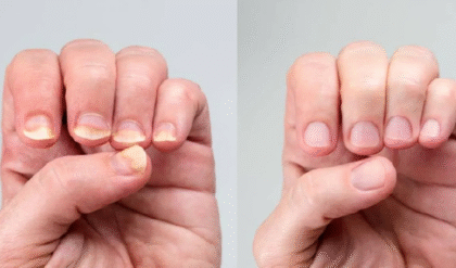 নখ দিয়ে যেসব রোগ যায় চেনা, জানলে অবাক হবেন