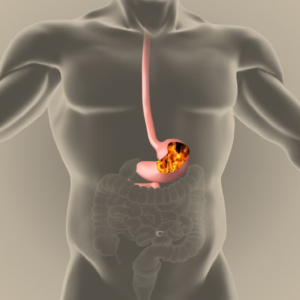 অ্যাসিডিটির জ্বালায় অস্থির? দ্রুত আরাম পেতে জানুন কী করবেন