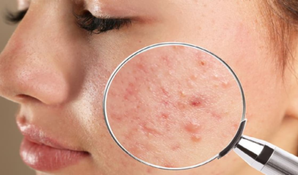 ব্রণের জ্বালায় জেরবার? কিছু উপকারি পন্থা আপনার জন্য
