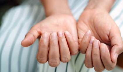 অনিয়ন্ত্রিত ডায়েটের ফলে ত্বকে যে যে সমস্যা হতে পারে, দেখুন