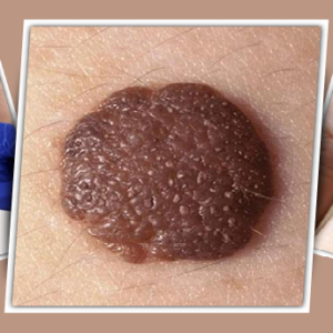 শরীরে আঁচিল হওয়া কি কোনো রোগের লক্ষণ? এই বিষয়ে চিকিৎসকরা কি বলছেন জেনেনিন