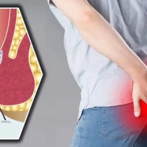 পাইলসের সমস্যা সমাধানের সেরা ৫ টি উপায় সম্পর্কে জেনেনিন এক্ষুনি