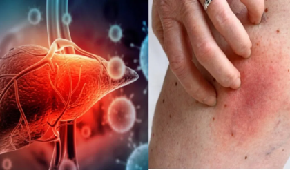 ফ্যাটি লিভারের প্রাথমিক উপসর্গগুলো জানা আছে কি? জানা না থাকলে পড়ুন ও সতর্ক থাকুন