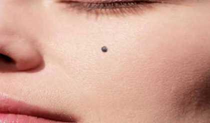 মুখের তিল কিসের ইঙ্গিত দেয় জানেন? অজানা তথ্যটি জানতে পড়ুন