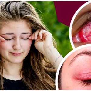 চোখে জ্বালাপোড়া, ব্যথা ও ফোলাভাব নিয়ে চিন্তায় রয়েছেন? চটজলদি সুস্থ হতে যা করবেন