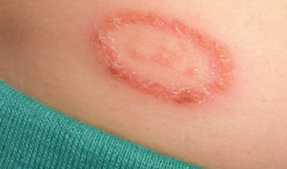 ত্বকেও কি প্রায়ই দাদ হয়? সমাধের সহজ রাস্তা জানুন একনজরে