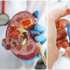 অনিয়ন্ত্রিত ব্লাড সুগার কিডনিকে ধ্বংস করে দিতে পারে, সতর্ক থাকুন ও জেনেনিন