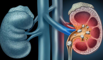 কিডনিতে পাথর জমার বা হওয়ার কারণ জানতে চান? তাহলে পড়ুন