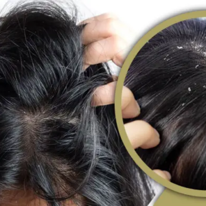 খুশকির যন্ত্রণায় অতিষ্ঠ? চিরতরে মুক্তি পেতে যা করবেন