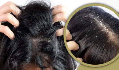 খুশকির যন্ত্রণায় অতিষ্ঠ? চিরতরে মুক্তি পেতে যা করবেন