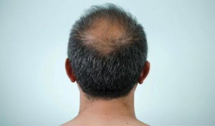 চুল ঝরে মাথায় টাক পড়ে গেছে? চুলের সঠিক হাল ফেরাতে কী করবেন দেখুন