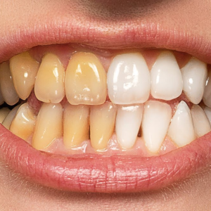 কেন আমার দাঁত হলুদ? সমাধান কীভাবে করবেন জানুন