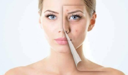 মুখে ব্রণ বেড়েই চলেছে? যেসব ভুলগুলো করবেন না, সতর্ক থাকুন