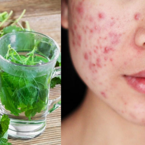 পার্লার নয়, বাড়িতেই হবে বাজিমাত! পুদিনা পাতা দিয়ে ব্রণ ও দাগ দূর করার অব্যর্থ উপায়