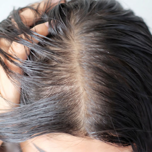 মাথার তালু কি দেখা যাচ্ছে? পাতলা চুল ঘন ও কালো করার ৩টি ম্যাজিক পদ্ধতি জেনে নিন