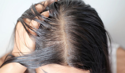 মাথার তালু কি দেখা যাচ্ছে? পাতলা চুল ঘন ও কালো করার ৩টি ম্যাজিক পদ্ধতি জেনে নিন