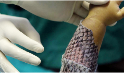 পোড়ার ক্ষত সারাতে এবার তেলাপিয়া মাছের ম্যাজিক! যন্ত্রণাহীন নিরাময়ে বিশ্বজুড়ে হইচই