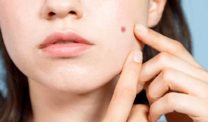 . সিঙ্গারার জাদুতে কমবে ব্রণের দাগ? অবাক করা তথ্য দিচ্ছে এই সমীক্ষা!