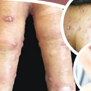 একবার পক্স হলে কি আর হয় না? প্রচলিত ধারণা ভেঙে সতর্ক করলেন চিকিৎসকরা, হু হু করে বাড়ছে সংক্রমণ!