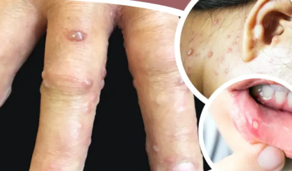 একবার পক্স হলে কি আর হয় না? প্রচলিত ধারণা ভেঙে সতর্ক করলেন চিকিৎসকরা, হু হু করে বাড়ছে সংক্রমণ!