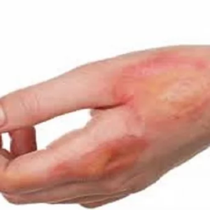 পুড়ে গেলে ভুল করেও টুথপেস্ট লাগাবেন না! জেনে নিন আরাম পাওয়ার সঠিক ঘরোয়া পদ্ধতি