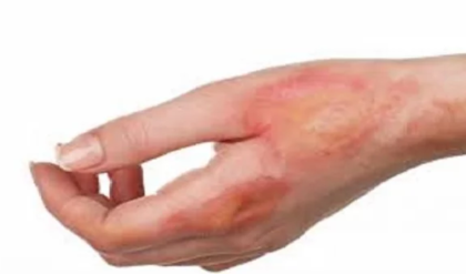 পুড়ে গেলে ভুল করেও টুথপেস্ট লাগাবেন না! জেনে নিন আরাম পাওয়ার সঠিক ঘরোয়া পদ্ধতি