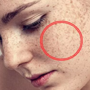 গায়ের সাদা ছোপ বা ছুলি নিয়ে চিন্তিত? ১ সপ্তাহ এই ঘরোয়া উপায়েই মিলবে চিরমুক্তি