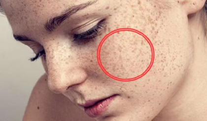 গায়ের সাদা ছোপ বা ছুলি নিয়ে চিন্তিত? ১ সপ্তাহ এই ঘরোয়া উপায়েই মিলবে চিরমুক্তি