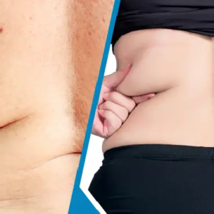 মেদহীন পিঠ পেতে চান? জিম ছাড়াই বাড়িতে ট্রাই করুন এই ৩টি কার্যকরী উপায়