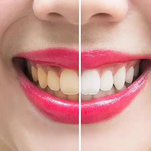 হলদেটে দাঁত নিয়ে হাসতে লজ্জা? মাত্র ৭ দিনে পান মুক্তোর মতো ঝকঝকে হাসি!