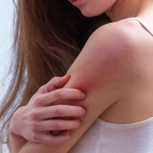 গরমে ঘামাচির যন্ত্রণায় ছটফট করছেন? এই ৩টি ঘরোয়া টোটকাতেই মিলবে চিরমুক্তি!