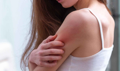 গরমে ঘামাচির যন্ত্রণায় ছটফট করছেন? এই ৩টি ঘরোয়া টোটকাতেই মিলবে চিরমুক্তি!