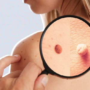 ত্বকের ওপর ছোট্ট এক দানা হতে পারে বড় বিপদ! আঁচিলের আড়ালে ক্যানসার চিনবেন কীভাবে?