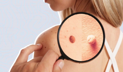 ত্বকের ওপর ছোট্ট এক দানা হতে পারে বড় বিপদ! আঁচিলের আড়ালে ক্যানসার চিনবেন কীভাবে?