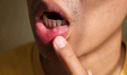 অবহেলা করলেই বিপদ! মুখের ভেতরে এই পরিবর্তনগুলো দেখলেই আজই চিকিৎসকের কাছে যান