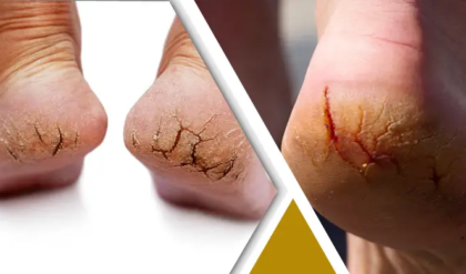 শুধু শীতকাল নয়, বারোমাস পা ফাটছে? শরীরে বাসা বাঁধেনি তো এই ৩টি মারণ রোগ?