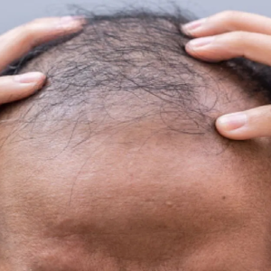 টাক নিয়ে দুশ্চিন্তায় ঘুম উধাও? নামী দামী ট্রিটমেন্ট ছাড়াই মাথায় গজাবে নতুন চুল!