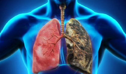 নারীদের মধ্যেও বাড়ছে ফুসফুসের ক্যানসার! ধূমপান না করলেও কি হতে পারে এই মারণ রোগ?