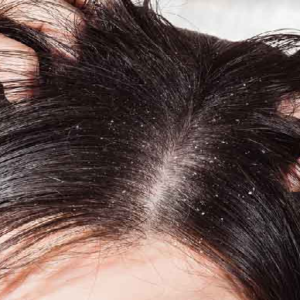 মাথায় কি সাদা সাদা চামড়া উঠছে? খুশকি ভেবে ভুল চিকিৎসা করছেন না তো? বড় বিপদ ঘটার আগে সাবধান!