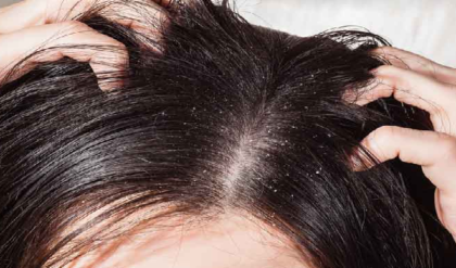 মাথায় কি সাদা সাদা চামড়া উঠছে? খুশকি ভেবে ভুল চিকিৎসা করছেন না তো? বড় বিপদ ঘটার আগে সাবধান!