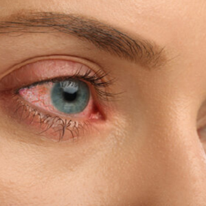 সারাক্ষণ চোখ লাল হয়ে থাকছে? একে সাধারণ ক্লান্তি ভেবে ভুল করবেন না, বড় বিপদের সংকেত নয়তো!