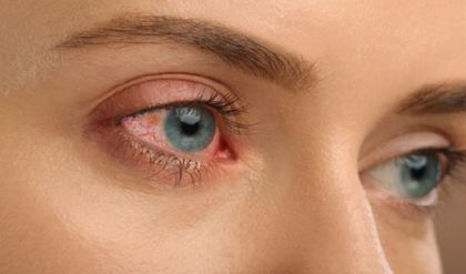 সারাক্ষণ চোখ লাল হয়ে থাকছে? একে সাধারণ ক্লান্তি ভেবে ভুল করবেন না, বড় বিপদের সংকেত নয়তো!